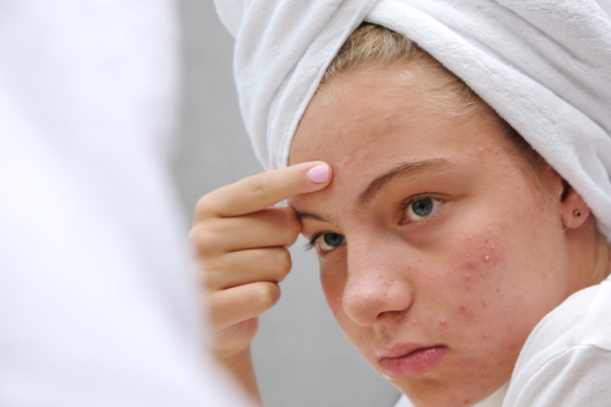 A sad teenage girl is looking at the pimples on her face in the mirror. Acne. Problematic skin in adolescents.