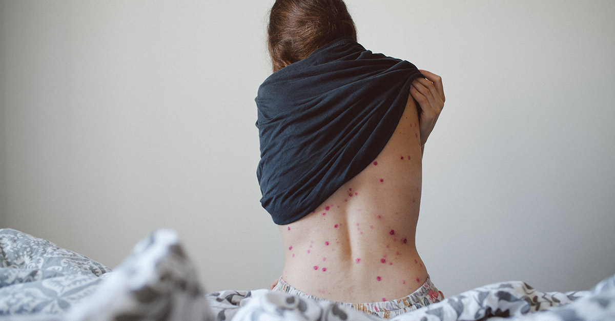 Measles vs Chickenpox: What are the differences?