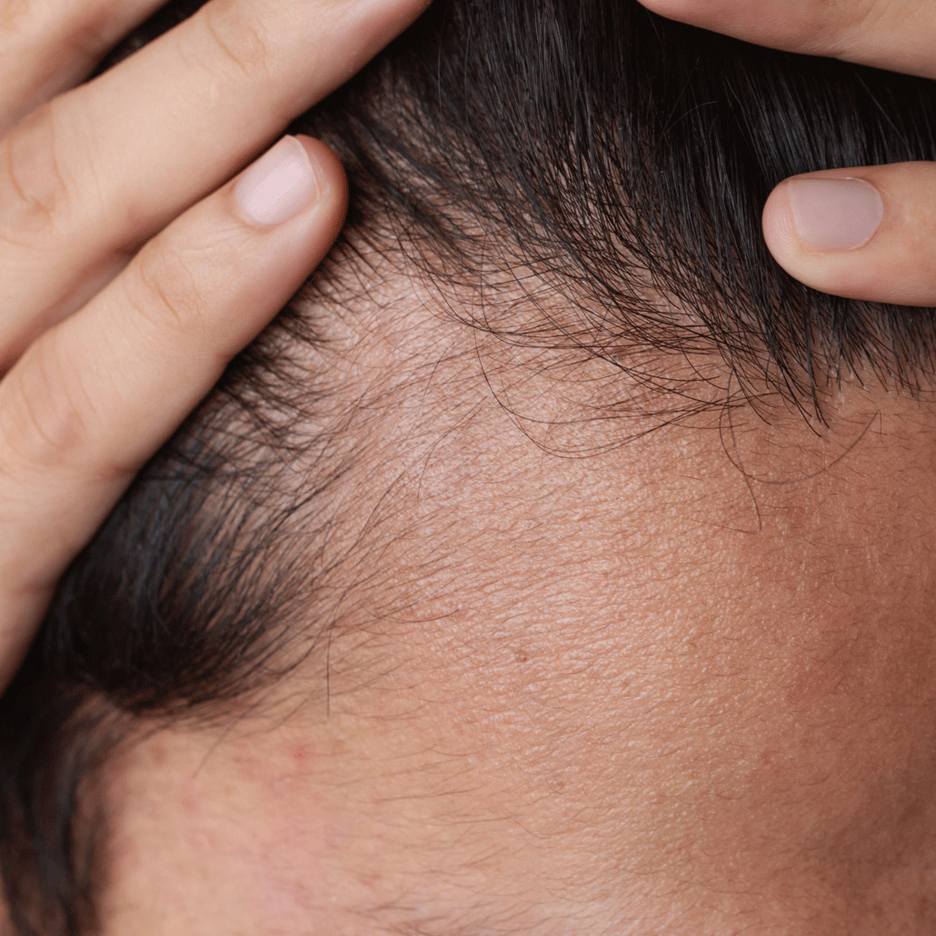 Comment stopper la perte de cheveux chez l