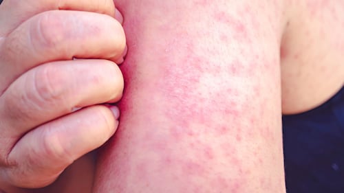 Rougeole: causes, symptômes et traitements