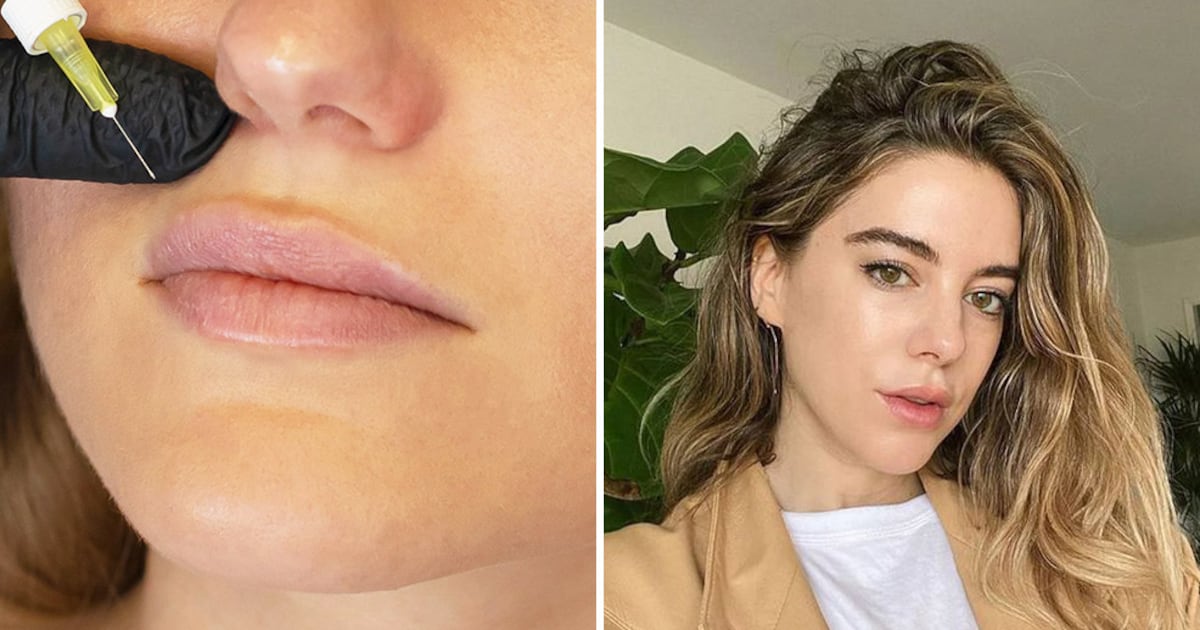 lip flip c'est quoi Lip flip: c'est quoi, résultats, coût et risques