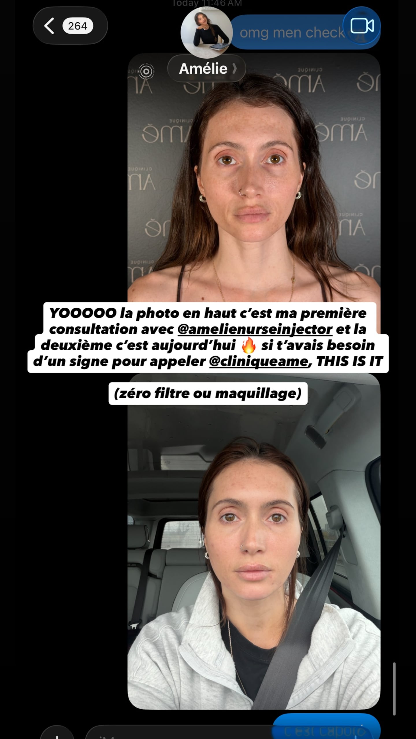Botox Authorization Lysandre Nadeau dévoile le avant/après de ses nouvelles injections